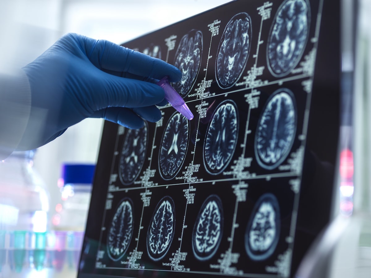 que es un ictus cerebral
