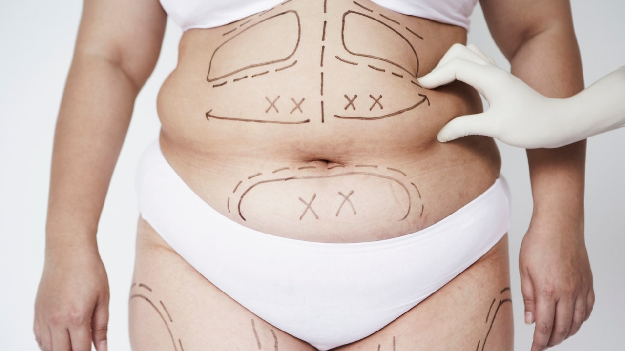 operacion estetica